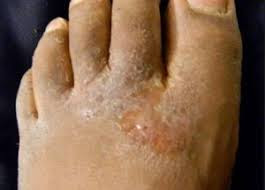 OBAT GATAL DI KAKI YANG AMPUH MENYEMBUHKAN GATAL MENAHUN