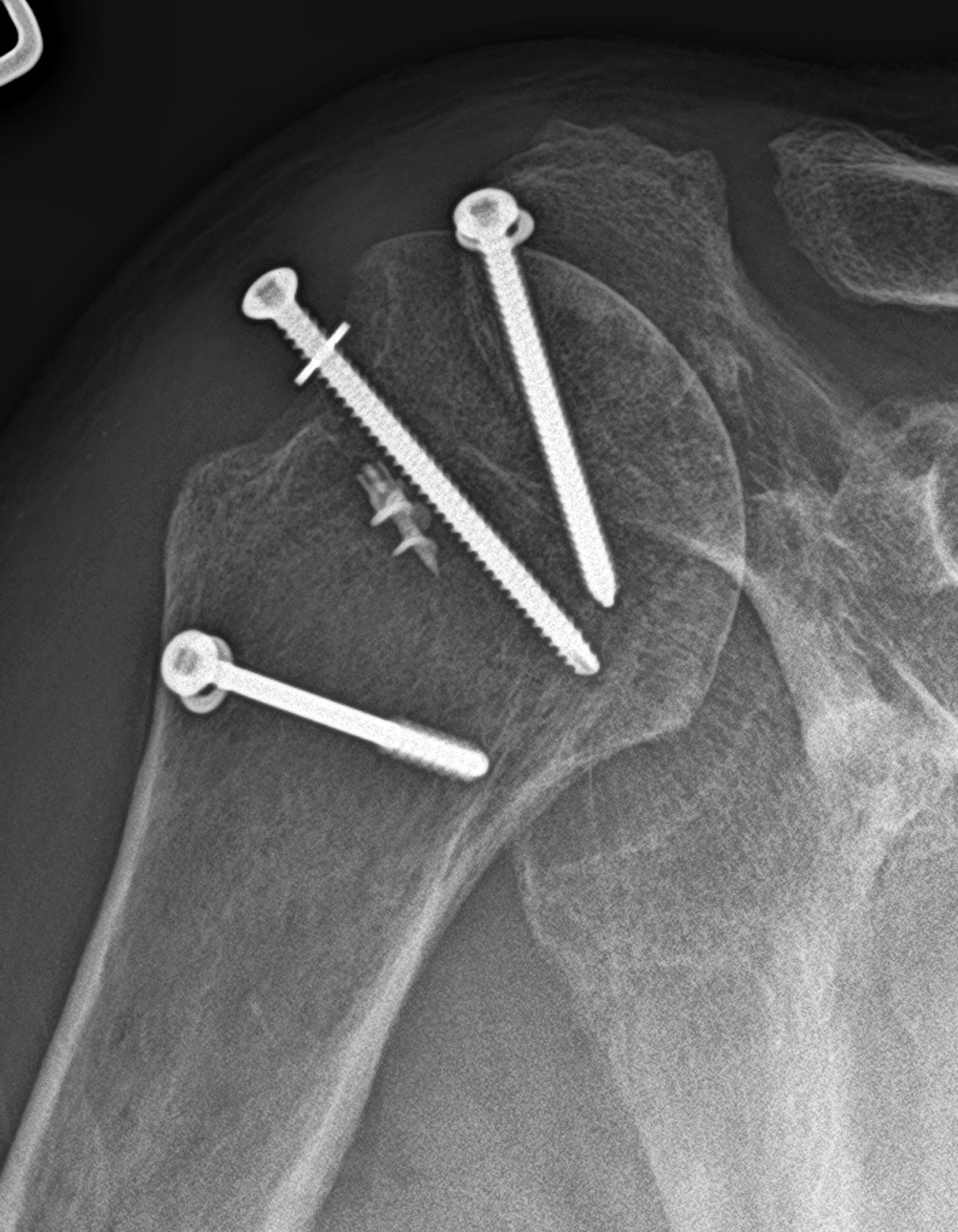 UW Shoulder and Elbow Academy Reverse total shoulder joint replacement