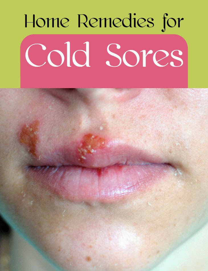 Cold Sores (Mouth Herpes)