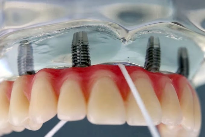 IMPLANTODONTIA: Como Higienizar os Implantes Dentários (3 Técnicas de Higienização)