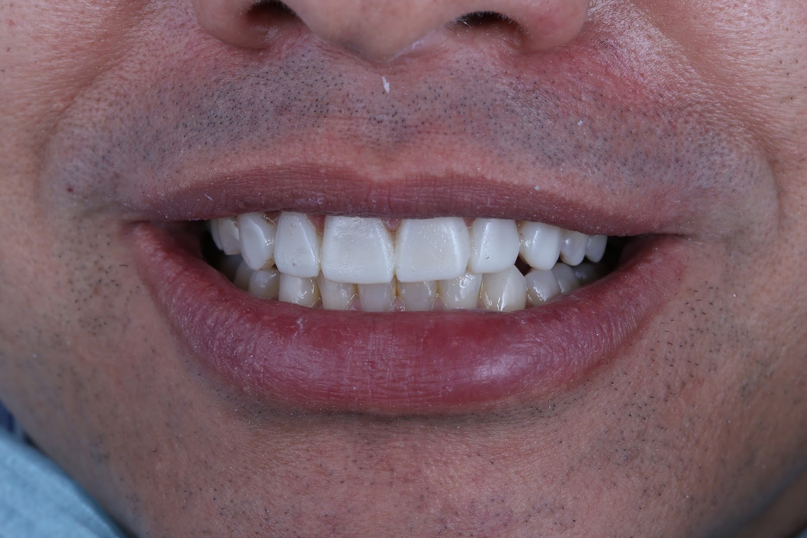 O que é Mockup dental? Araújo e ginger Odontologia Estética