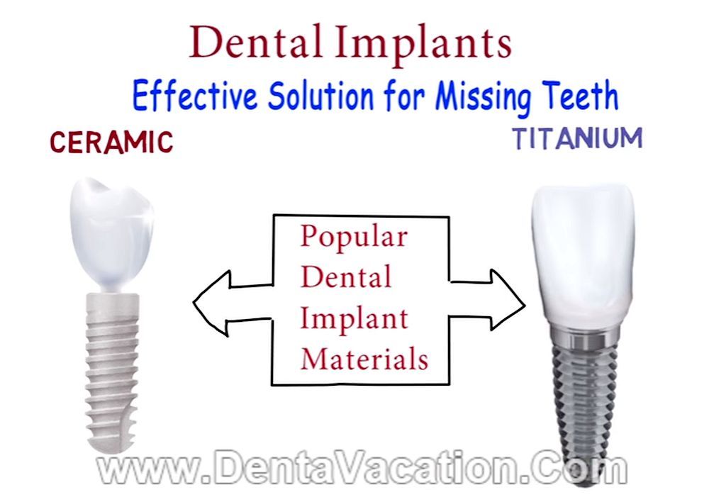 IMPLANTOLOGY Zirconia Vs Titanium Dental Implants