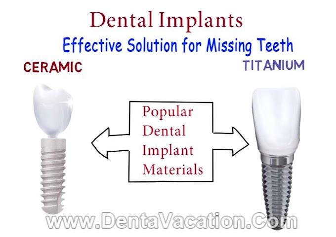 IMPLANTOLOGY: Zirconia Vs Titanium Dental Implants
