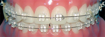 Ortodontyczny aparat