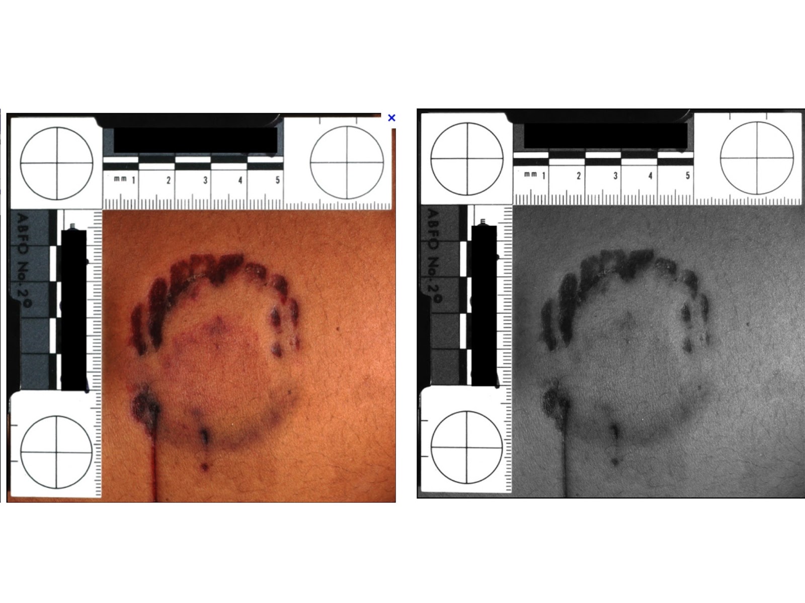 ANÁLISE DAS MARCAS DE MORDIDA Dicas