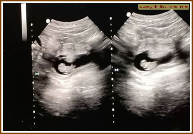 9 haftalık bebeğin görüntüsü