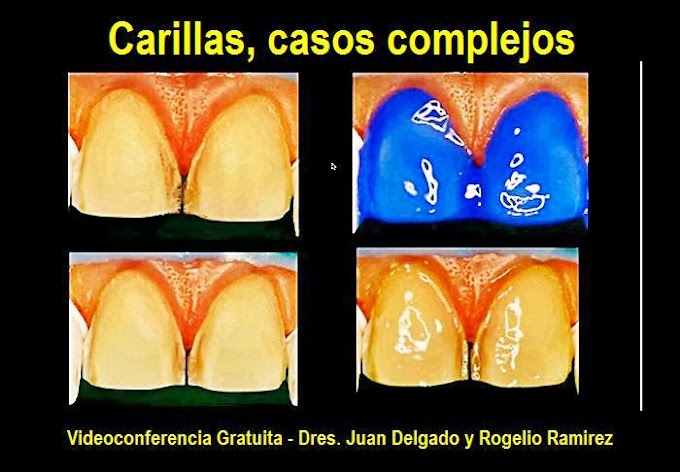 CARILLAS DENTALES: Casos Complejos - Videoconferencia de los Dres. Juan Delgado y Rogelio Ramirez