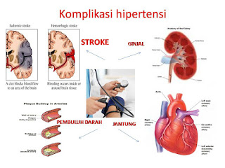 Penyebab, Akibat dan Cara Menurunkan Darah Tinggi Atau Hipertensi Penyebab, Akibat dan Cara Menurunkan Darah Tinggi Atau Hipertensi