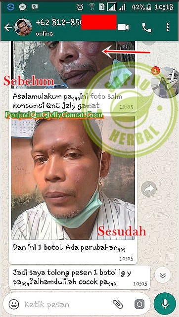 Cara Menghilangkan Bintik Merah Seperti Jerawat Di Kulit Perut Terbukti Mujarab ~ TESTIMONI QNC JELLY GAMAT Cara Menghilangkan Bintik Merah Seperti Jerawat Di Kulit Perut Terbukti Mujarab ~ TESTIMONI QNC JELLY GAMAT