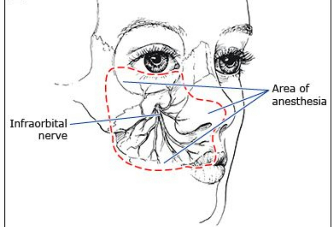 Cpt For Infraorbital Nerve Block