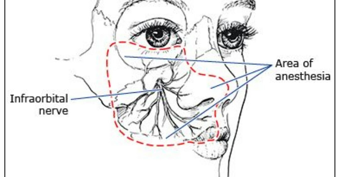 Infra Orbital Nerve Block