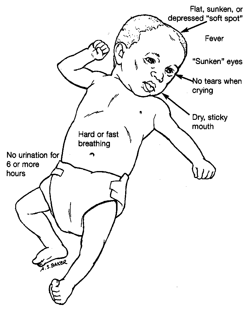 sunken fontanelle USA News Collections