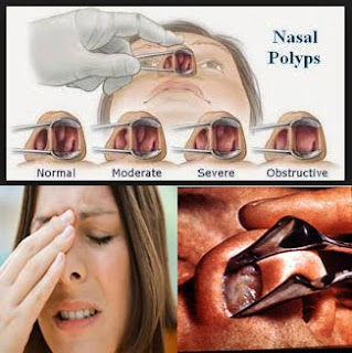 Pengobatan Ampuh Cara Mengangkat Polip Hidung Tanpa Operasi 100% Aman, Efektif Dan Cepat