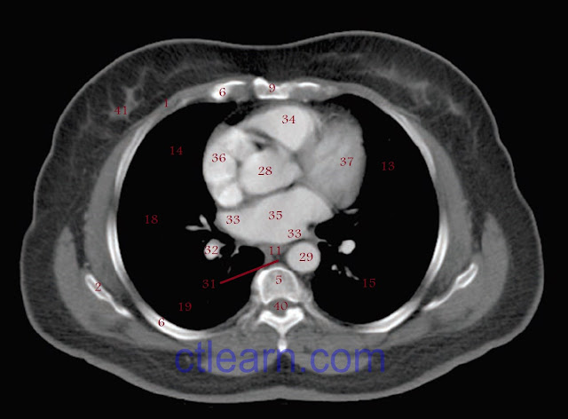 Anatomy CT Axial thorax 