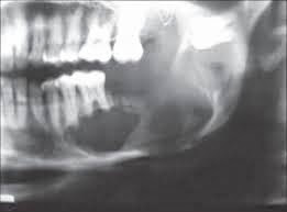 patogenia del ameloblastoma uniquístico de la diabetes