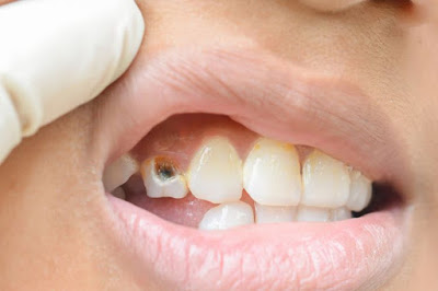 7 Cara Mencegah Gigi Berlubang Menurut Ahli