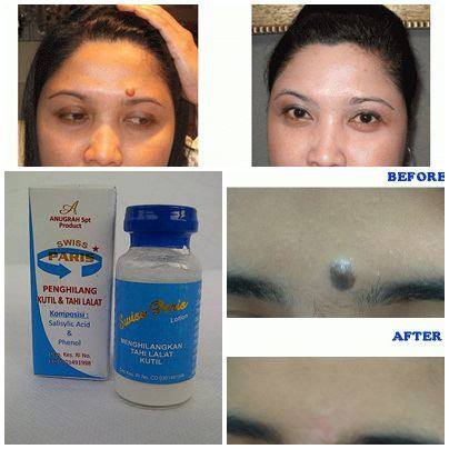 Swiss Paris Lotion Penghiang Kutil Dan Tahi Lalat Review Swiss Paris Lotion Original Penghilang Kutil Dan Tahi Lalat