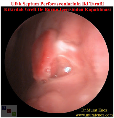 Nasal septum perforation - Septum perforation repair in Istanbul - Repairing of septum perforation - Patients with septum perforation - Doctors who is performing septum perforation repair in Istanbul - Hole on the nasal septum - Septum perforation surgery - Septum perforation - Septal perforation repair  in Istanbul - Small septum perforation repair - Intranasal repair of small septum perforation in Turkey