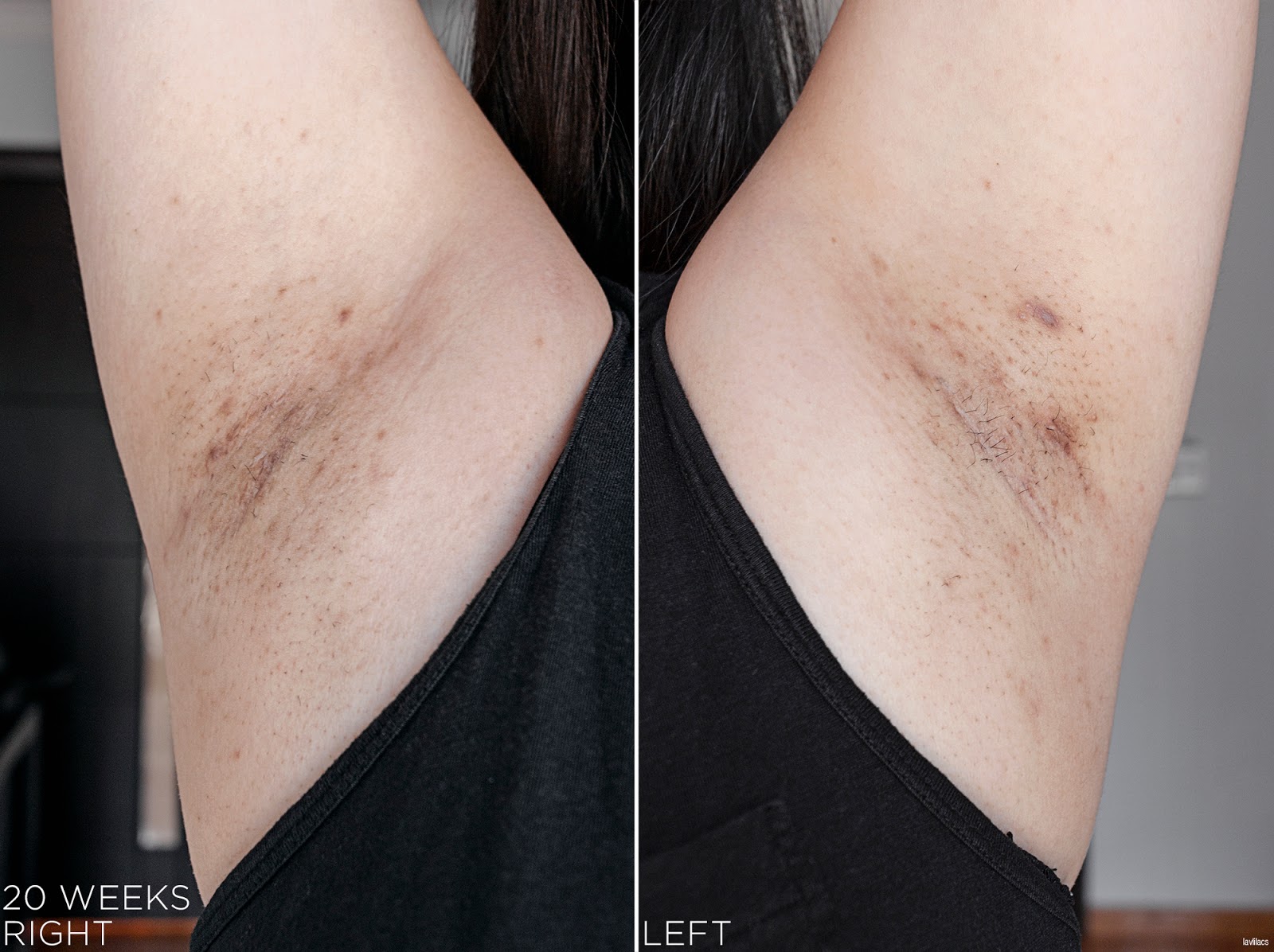 tria Hair Removal Laser Armpits Hair 20 Weeks