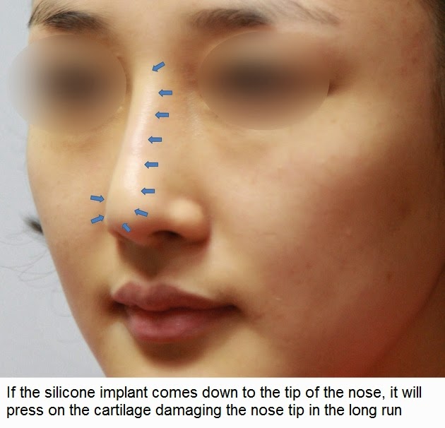Silicone Nose Implant 16