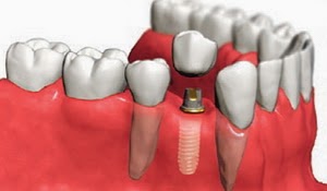 chirurgie dentaire implant