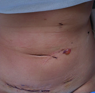 kidney donor organ donation surgery recovery scar