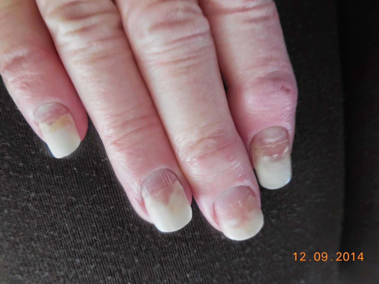 CHOCOLATE, One of My Many Addictions Chemo Side Effect Bad, Ugly