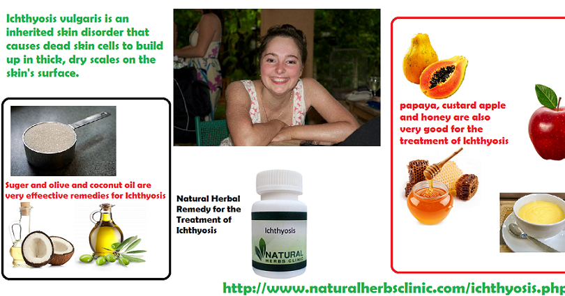 Coconut Oil for Ichthyosis