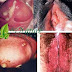 Obat Kencing Nanah Tradisional Di Apotik