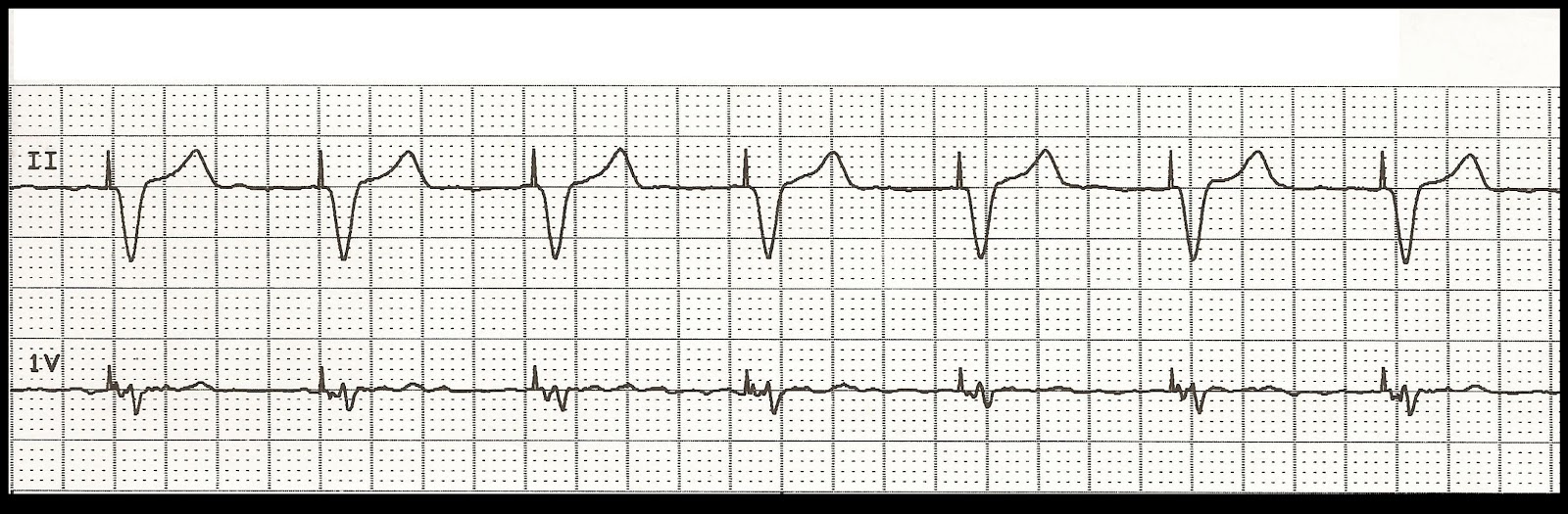 Float Nurse EKG Rhythm Strip Quiz 100 Paced rhythms