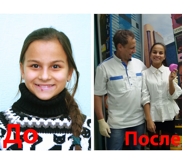 Улыбка до и после лечения брекетами Лицо до и после раннего ортодонтического лечения