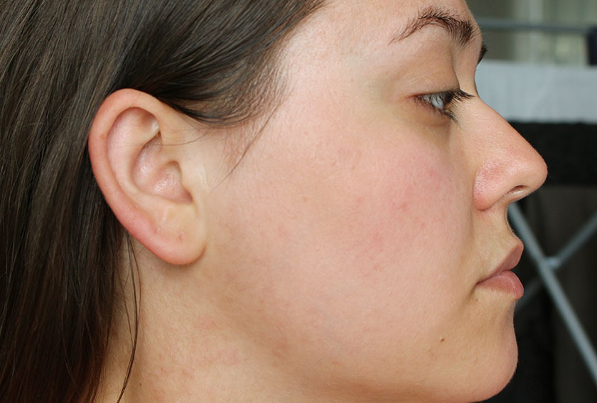 glycolic acid peels glasgow skin clinic before and after