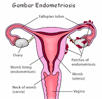 pengobatan penyakit kista ovarium