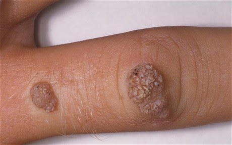 Natural Way To Cure Warts Natural Way To Cure Warts
