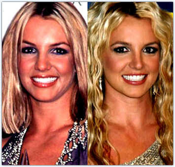 Plastic Surgery Before and After: The Best Celebrity nose jobs