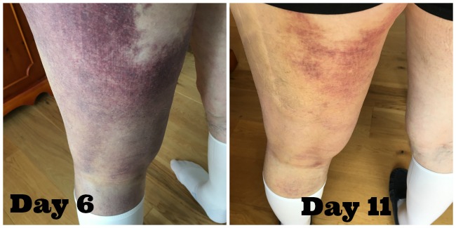 Hip-replacement-one-mans-journey-week-2-collage-images-bruised-leg-day-6-and-day-11