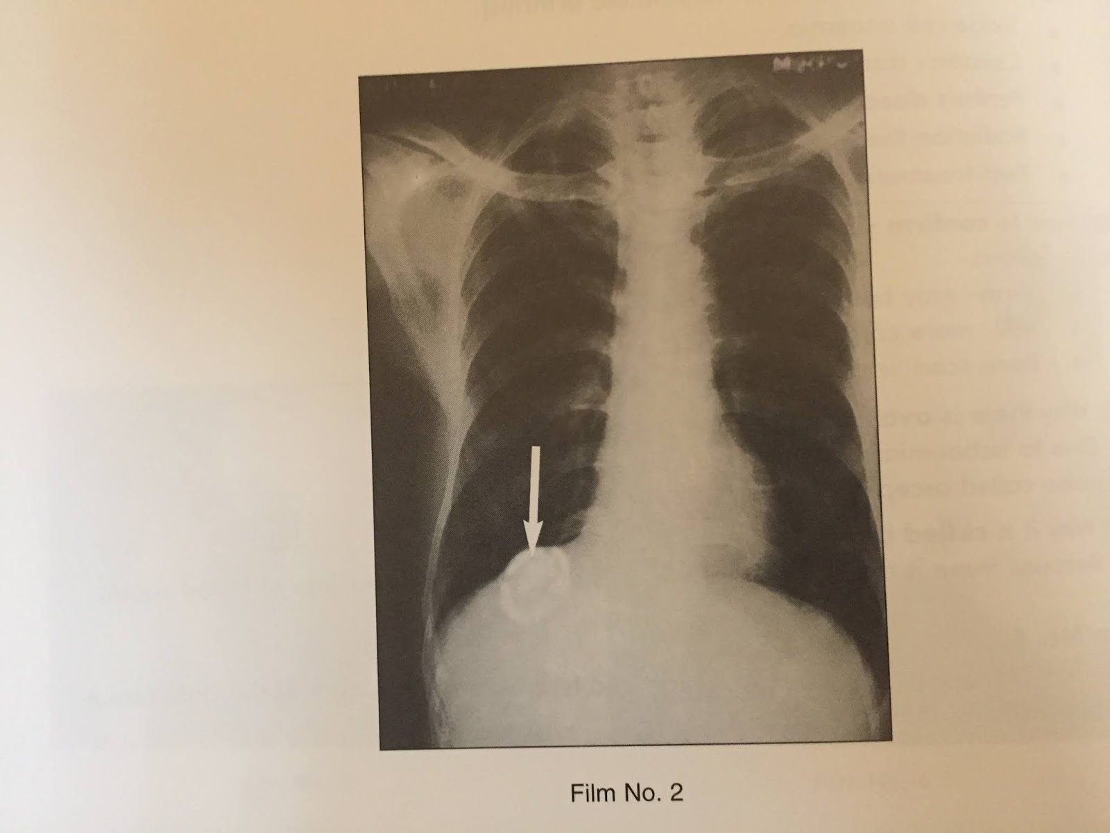 XRAYS HYDATID CYST OF THE LIVER