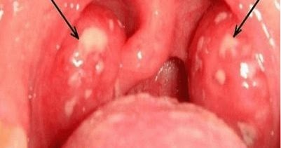 fever adults Strep in throat without