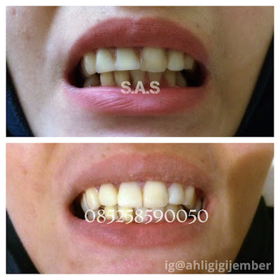 gigi tiruan permanent crown bridge estetika gigi kecantikan gigi