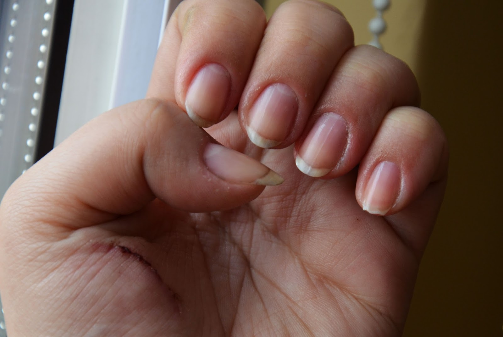 kuracja-nail-tek kuracja-nail-tek