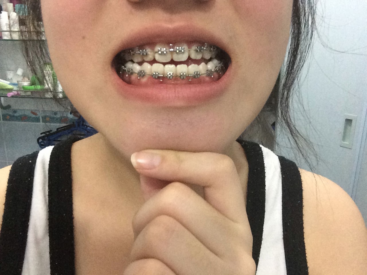 Orthognathic Jaw Surgery Singapore Blog Surgical Hooks On!