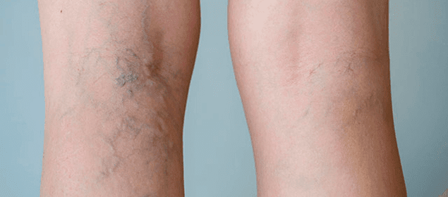 remedios para atenuar las varices