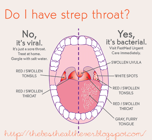 Gallery For Normal Throat Pictures Vs Strep
