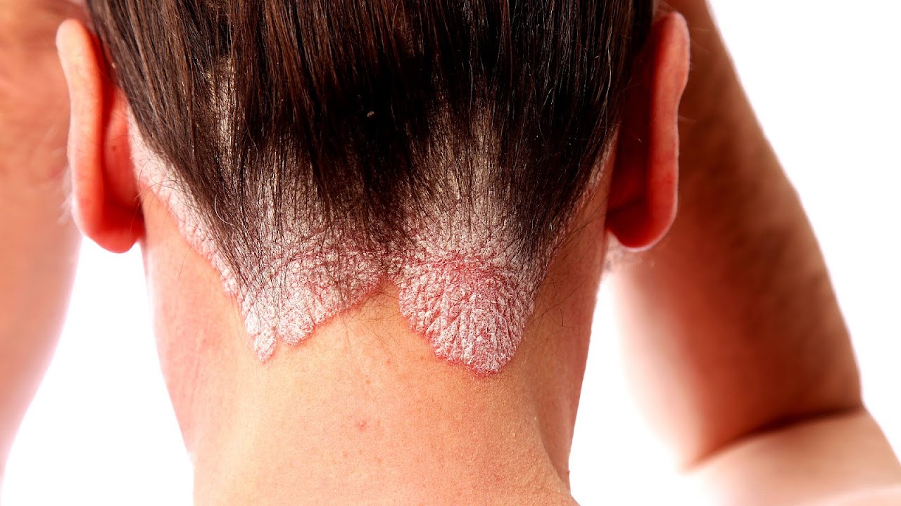 The Best Psoriasis Treatment