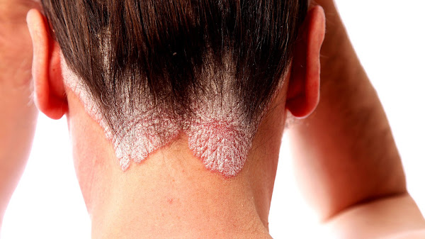 The Best Psoriasis Treatment