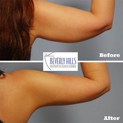 Beverly Hills MD – Lift and Firm