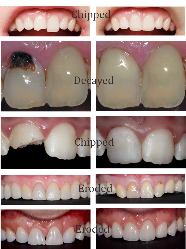 Composite Teeth Filling in Jamnagar Dr. Bharat Katarmal Dental