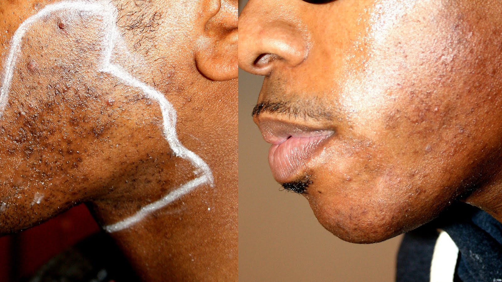 American Hair Laser Removal American Choices