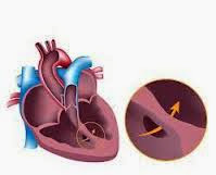 Obat Jantung Bocor Bayi