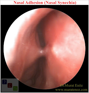 Nasal Cavity Adhesion - Intranasal Synechia - Nasal Adhesion - Nasal Synechia - Treatment of  Nasal Synechia -  Causes of  Nasal Synechia - Sympoms of  Nasal Synechia - Definition of Nasal Synechia